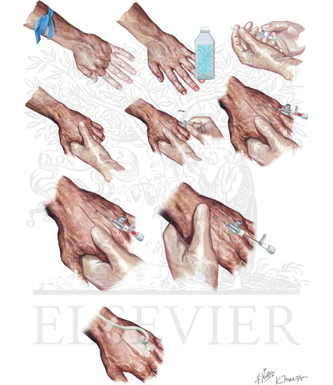 Landmark approach to peripheral intravenous cannulation
