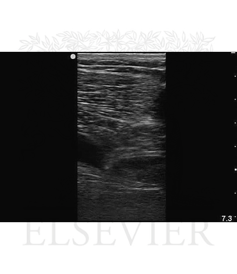 Watermarked preview of unlabeled image: Ultrasound view of venous cannulation