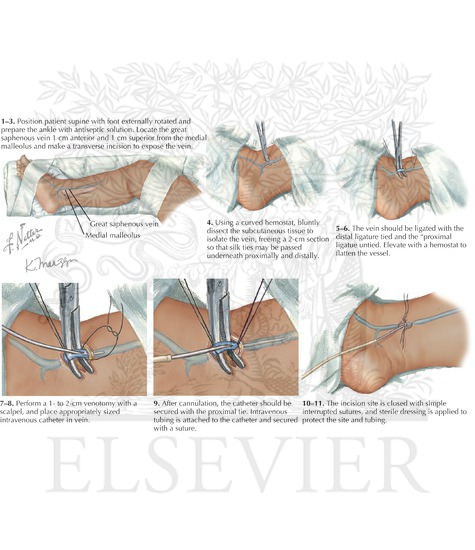 Venous cutdown: forearm veins
