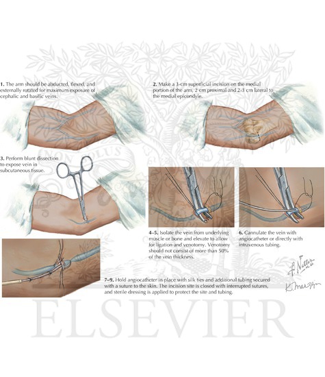 Venous cutdown: distal great saphenous vein