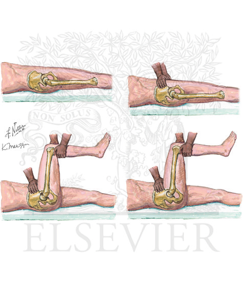 Dislocated Hip Reduction: Allis Maneuver