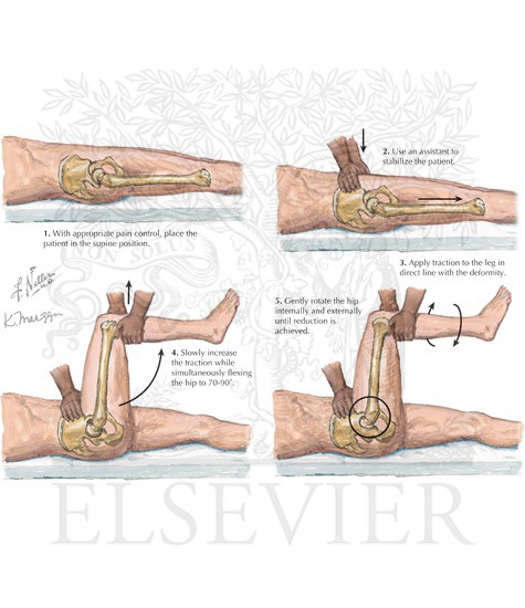 Dislocated Hip Reduction: Allis Maneuver