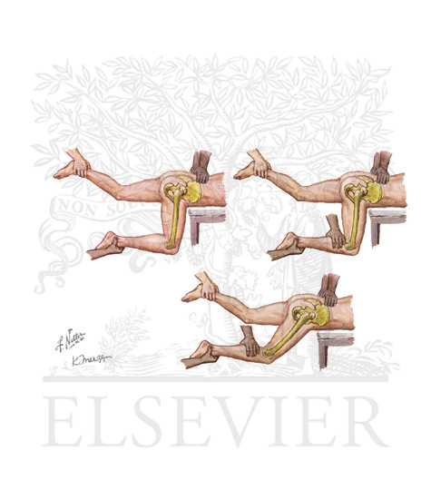 Dislocated Hip Reduction: Stimson Maneuver