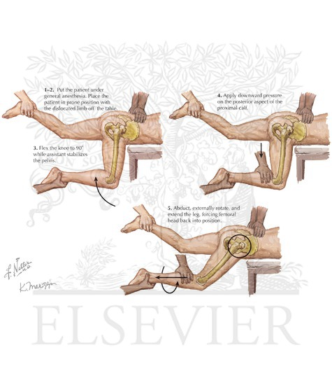 Dislocated Hip Reduction: Stimson Maneuver