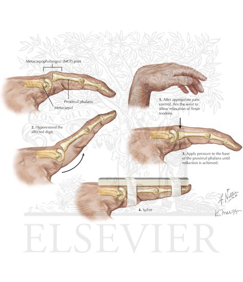 Dislocated finger reduction: metacarpophalangeal dislocations