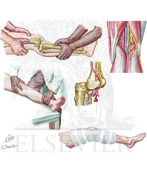 Dislocated Knee Reduction