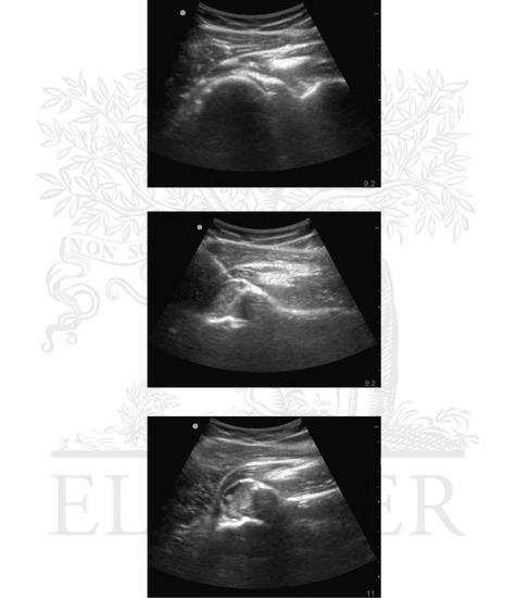 Watermarked preview of unlabeled image: Ultrasound of normal (A) and anteriorly dislocated (B and C) shoulder joint