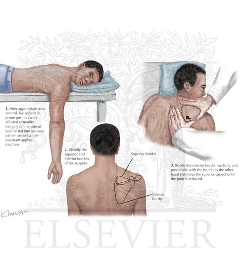 Dislocated Shoulder Joint Reduction : Scapular Manipulation