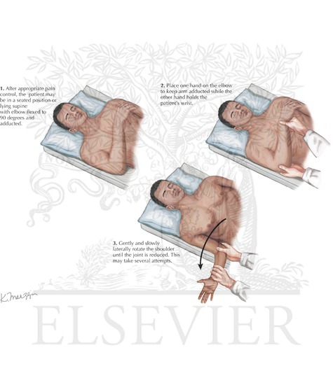 Dislocated Shoulder Joint Reduction : Lateral Rotation Maneuver