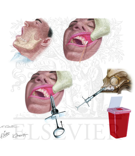 Superior Alveolar Nerve Block