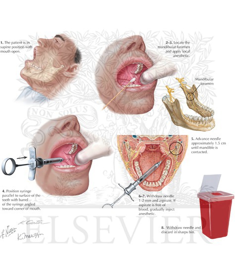 inferior alveolar nerve block