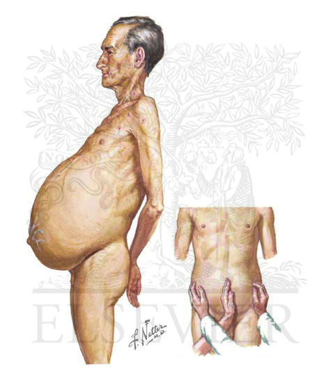 Watermarked preview of unlabeled image: Ascites 