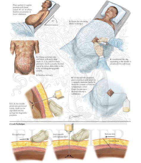 paracentesis