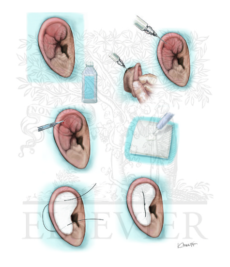 Incision and drainage for auricular hematoma