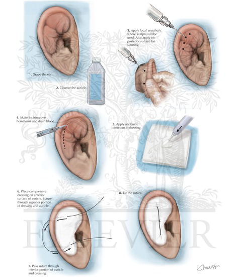 Incision And Drainage For Auricular Hematoma