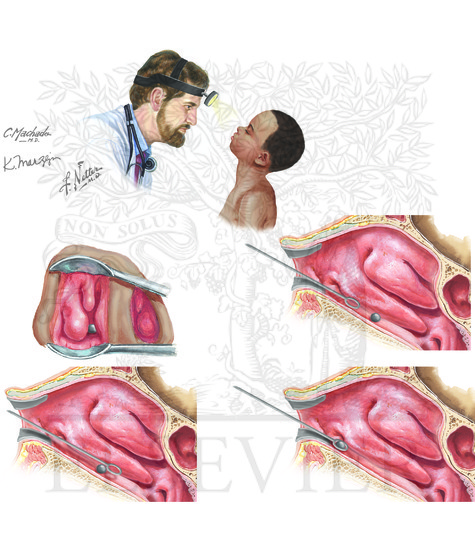 Watermarked preview of unlabeled image: Direct Removal of Foreign Body in Nose