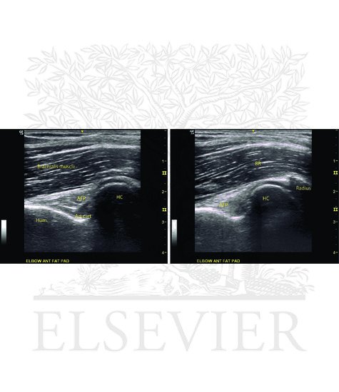 Watermarked preview of unlabeled image: Ultrasound imaging of the elbow joint.ï¿½