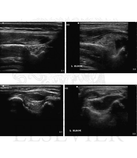 Ultrasound imaging of normal elbow joint and elbow joint effusion