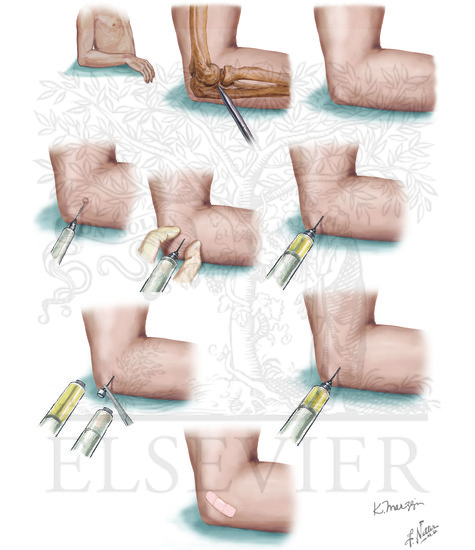 Elbow Joint Aspiration