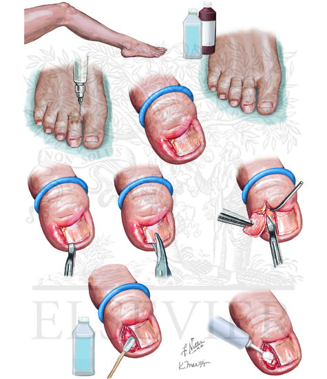 Ingrown Toenail Removal