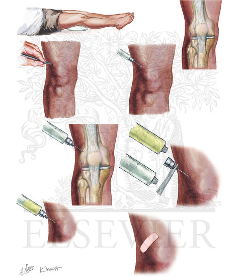 Watermarked preview of unlabeled image: Knee Joint Aspiration