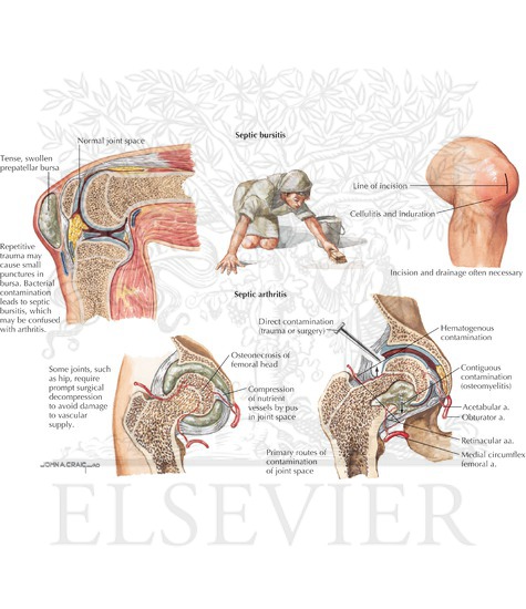 Septic Bursitis and Arthritis