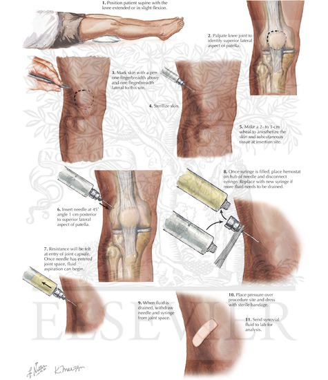 Knee Joint Aspiration