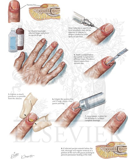 Paronychia incision and drainage