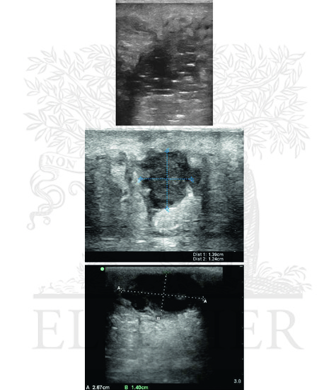 Ultrasound imaging of abscesses