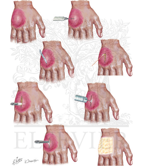 Skin Abscess Incision And Drainage