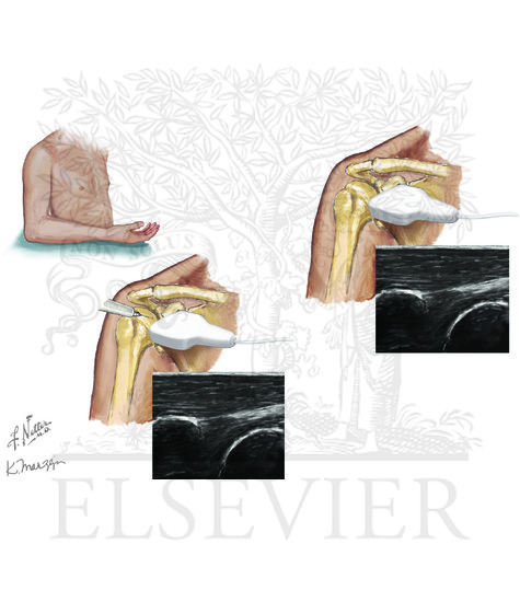 Shoulder joint aspiration: anterior approach