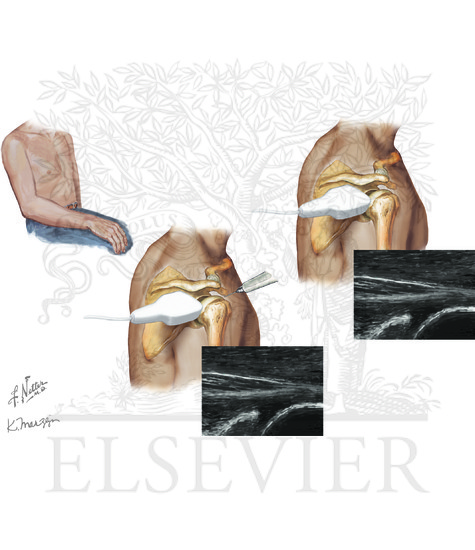 Shoulder joint aspiration: posterior approach