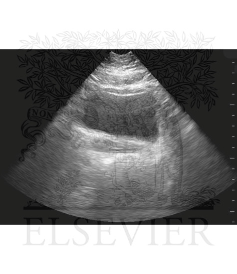 Transverse bladder ultrasound image