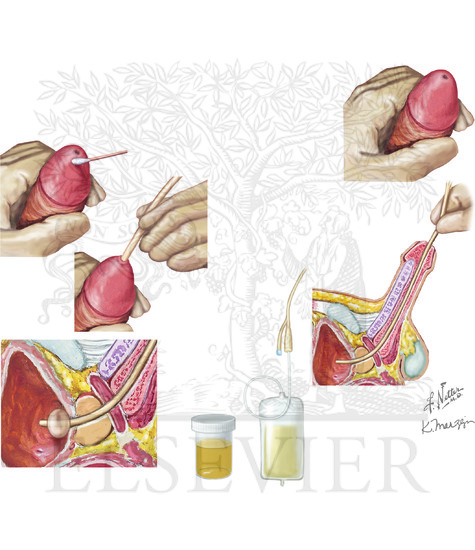 Transurethral (Foley Catheter) Urinary Bladder Catheterization: Male