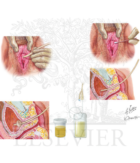 Transurethral (Foley Catheter) Urinary Bladder Catheterization: Female