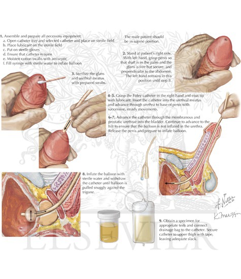 Transurethral Foley Catheter Urinary Bladder Catheterization Male