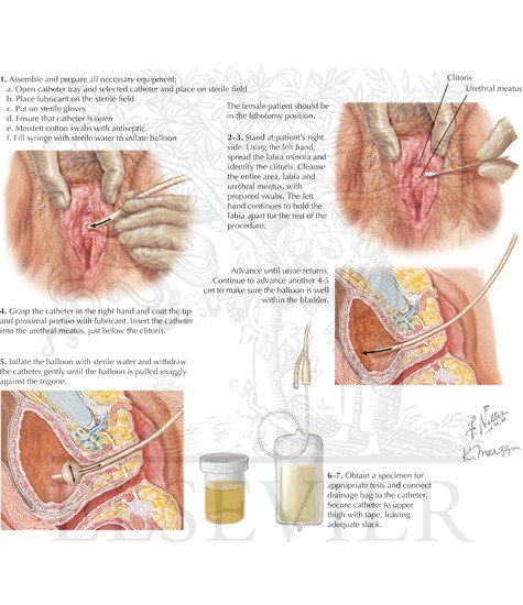 Transurethral Foley Catheter Urinary Bladder Catheterization Female