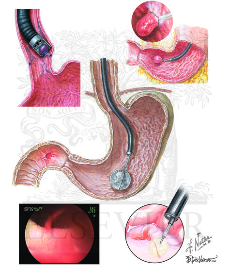 Endoscopic Evaluation of the Upper Digestive Tract