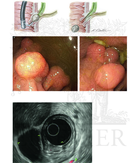 Endoscopic Evaluation of the Upper Digestive Tract (CONTINUED)
