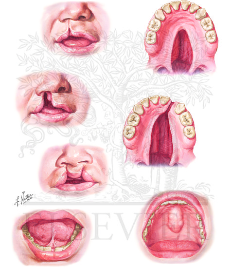 Watermarked preview of unlabeled image: Congenital Anomalies of Oral Cavity