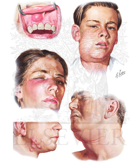 Odontogenic Infections: Their Spread and Abscess Formation (Continued): Abscess Formation