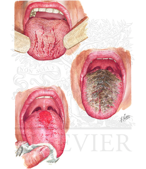 Manifestation of Tongue: Fissured tongue, hairy tongue, median rhmboid glossitis