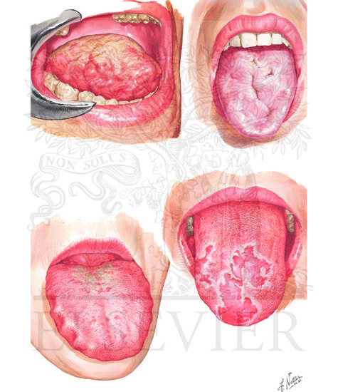 Watermarked preview of unlabeled image: Manifestation of Tongue: Amyloid tongue, Luetic glossitis, geographic tongue, megaloglossia