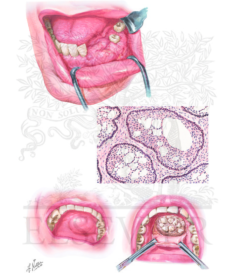 Benign Tumors of Oral Cavity (CONTINUED)