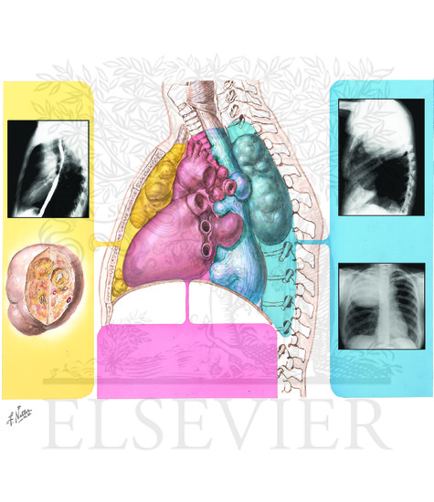 Esophageal Duplication Cysts 