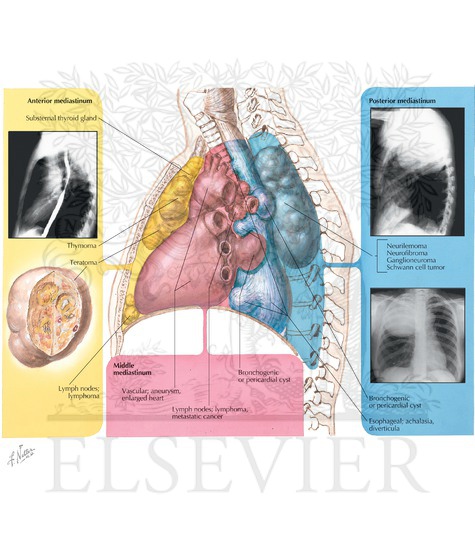 Esophageal Duplication Cysts 