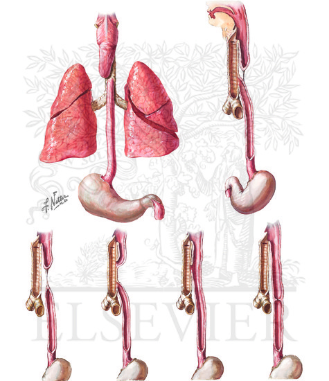 Congenital Esophageal Stenosis 