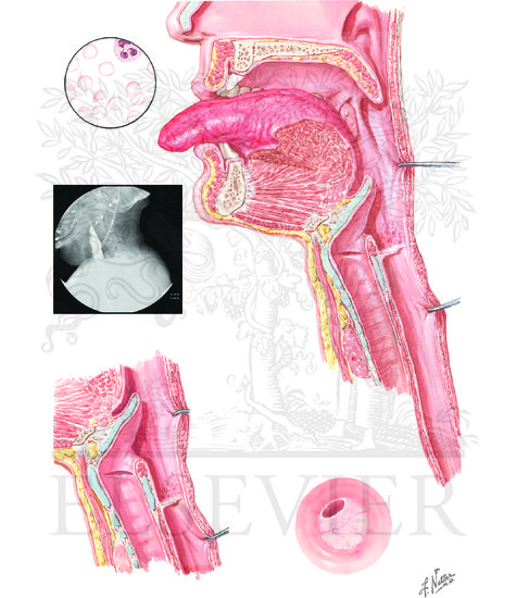 plummer vinson syndrome plummer vinson syndrome