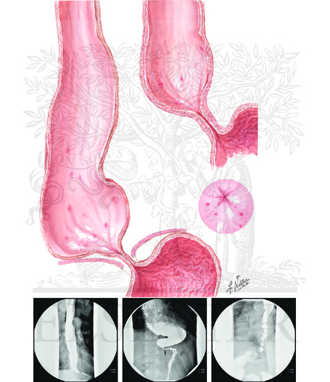 Watermarked preview of unlabeled image: Achalasia and Diffuse Esophageal Spasm 