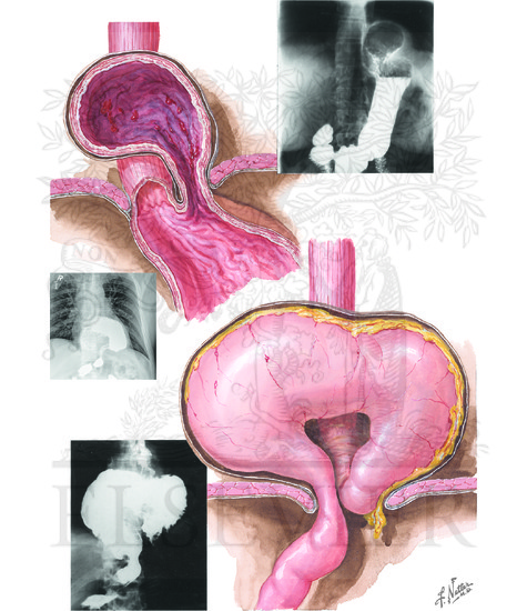 Sliding and Paraesophageal Hernia (Continued): Paraesophageal Hernias